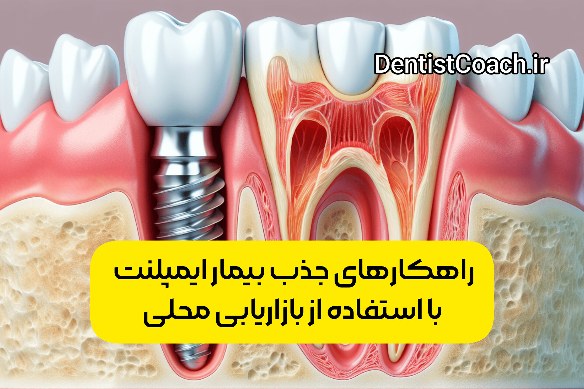 راهکارهای جذب بیمار ایمپلنت با استفاده از بازاریابی محلی