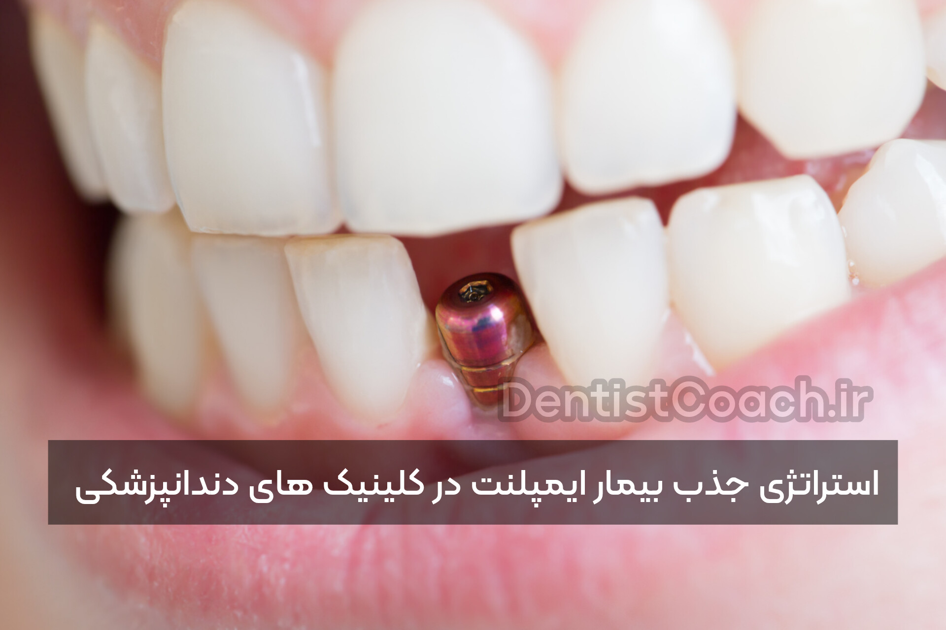 استراتژی جذب بیمار ایمپلنت در کلینیک های دندانپزشکی