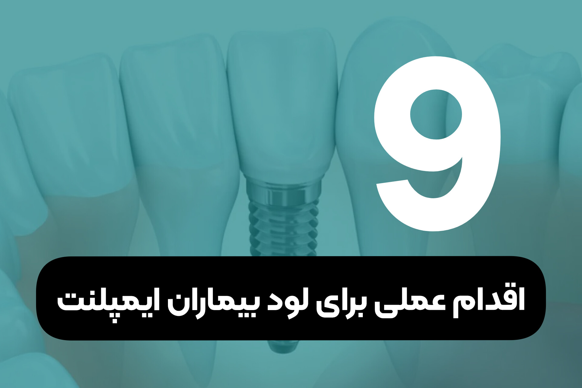۹ اقدام عملی برای لود بیماران ایمپلنت